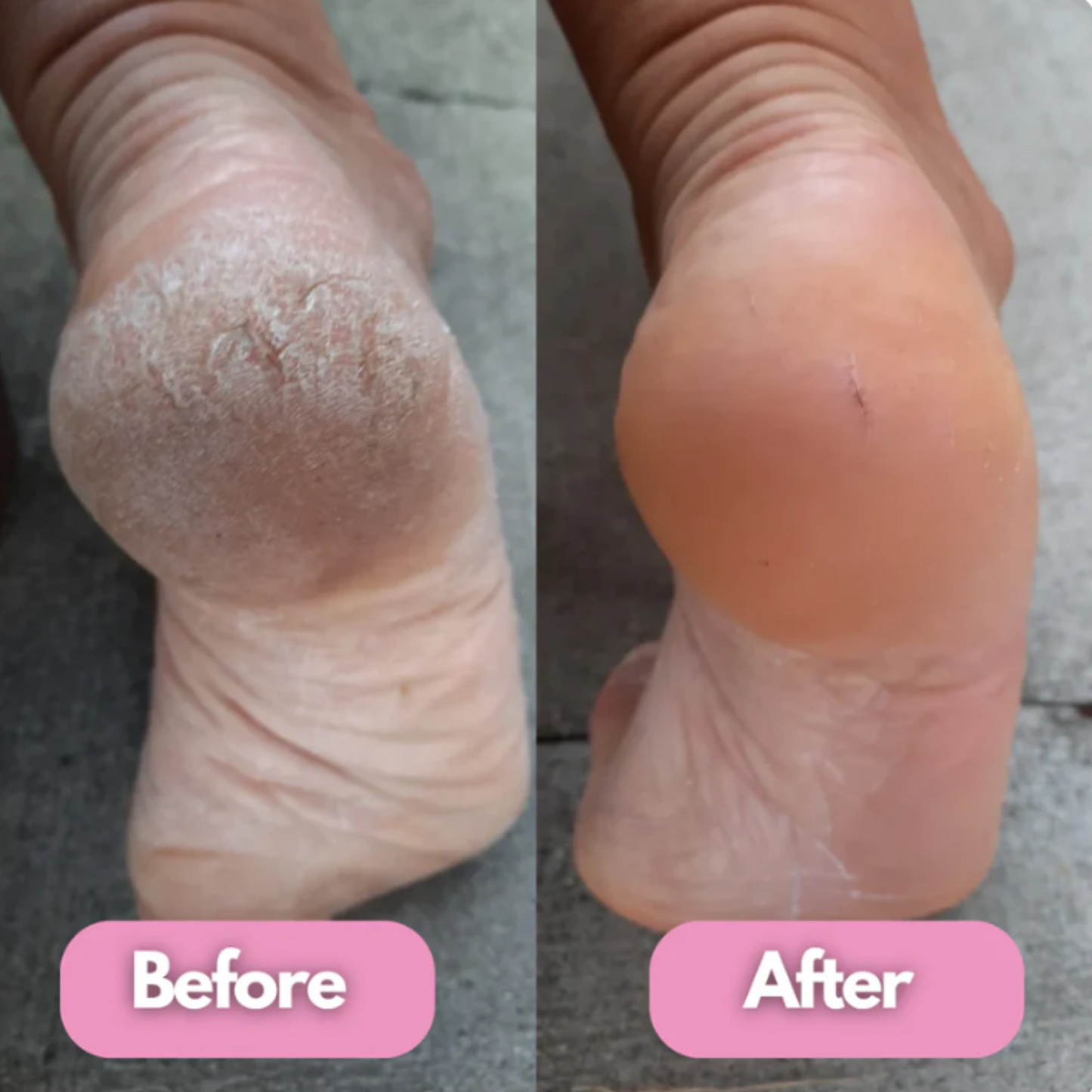 Permave™ Electric Foot Callus Remover